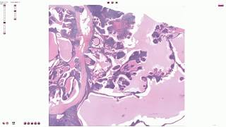 Warthin Tumor  Histopathology [upl. by Airdnat]