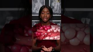 Sickle Cell Anaemia Explained and Simplified [upl. by Tri326]