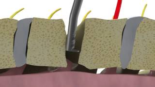 Removing osteophytes during ACDF using Dreal® technology [upl. by Leake443]