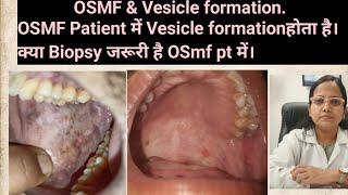 OSMF amp Vesicle formationOSMF Patient में Vesicle formation होता है तो क्या Biopsy जरूरी हैOSmf pt [upl. by Mindy198]