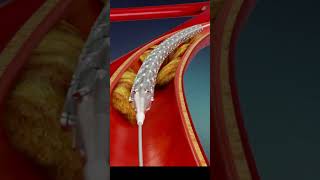 हार्ट के ब्लॉकेज का रामबाण इलाज Heart Angioplasty Explained in 3D Animation [upl. by Adel]