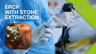 ERCP Practical Guide I Part 2 ERCP with Stone Extraction [upl. by Ryle965]