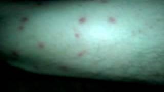 Chiggers Attacked on the 4th of July [upl. by Siol]