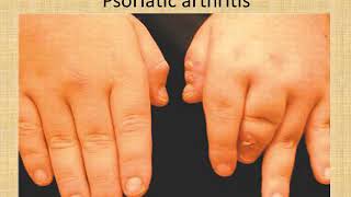 Approach to Polyarthritis Patient By Dr Haidy Ali [upl. by Leahcimsemaj]