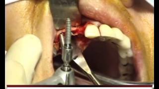 Implants dentaires  Chirurgie  Implantation sur crête mince avec Splint Crest  MAI 2014 [upl. by Atiras]