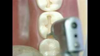 Class II amalgam cavity preparation GV Black Lower 2nd Molar Dr Ahmed Sleibi QMULUK [upl. by Yebot]