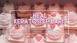 ♡ Heal Keratosis Pilaris ♡ [upl. by Nivri920]