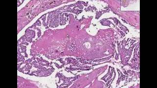 Histopathology BreastDuctal carcinoma in situ [upl. by Qidas]