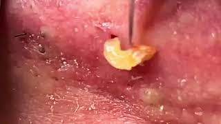 Super Satisfying Blackhead Removal from ear 2024 [upl. by Yk217]