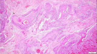 Glioblastoma IDH Wildtype Histopathological Diagnosis [upl. by Paresh635]