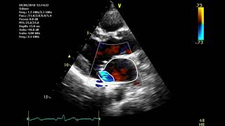 Echocardiographic assessment of the mitral valve [upl. by Ojiram]