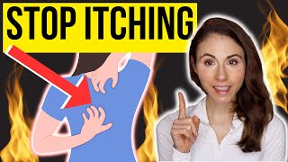 HOW TO STOP ITCHING ON THE BACK  Notalgia Paresthetica [upl. by Akcinahs]