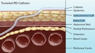 Complications of Peritoneal Dialysis by S Su  OPENPediatrics [upl. by Samara]