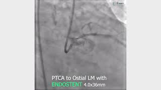 ENDOSTENT Sirolimus Eluting Coronary Stent System [upl. by Levin]