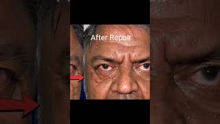 Lower eyelid ectropion before and after surgery [upl. by Leterg]