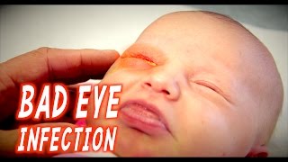 BAD EYE INFECTION Infant  Dr Paul [upl. by Parlin958]