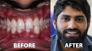 How to close Gap between teeth  Composite Bonding  FMS Dental Hospital  Hyderabad India [upl. by Loredo]