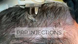 PRP for Hair  Level III Angel Arthrex rejuvenceclinic91 [upl. by Anaitat228]