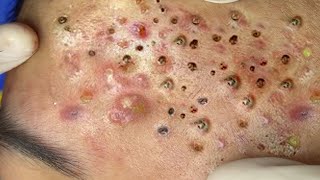 Big Cystic Acne Blackheads Extraction Blackheads amp Milia Whiteheads Removal Pimple Popping  2313 [upl. by Nnahgiel361]