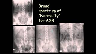 How to talk about the normal abdominal plain Xray [upl. by Elder]