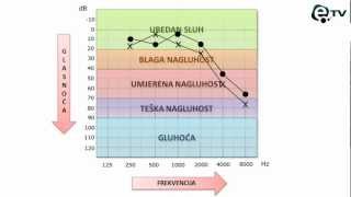 Kako pročitati audiogram [upl. by Edmead]