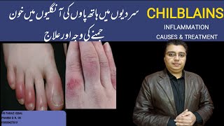 Chilblains Inflammation Sardion mean Hathon Paon ki Unglion Mean Ratt Jamnachilblains [upl. by Anial]