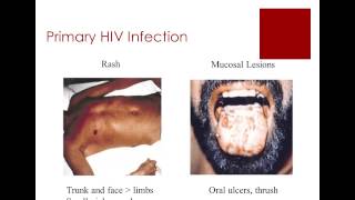 HIV for Primary Care Physicians [upl. by Leyes]