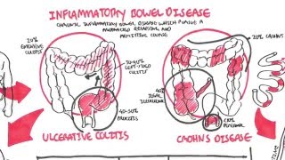 Inflammatory Bowel Disease  Crohns and Ulcerative Colitits [upl. by Eninahpets]