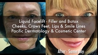 Liquid Facelift  Botox Lip Smile Line and Cheek Filler Volbella Juvederm Botox and Restylane [upl. by Sidhu22]