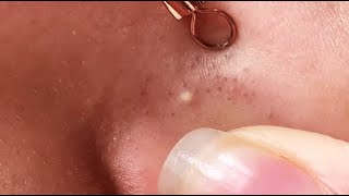 HOW YOU CAN REMOVE BLACKHEADS FROM NOSE AT HOME  RELAXING VIDEO WITH ELA [upl. by Othello949]