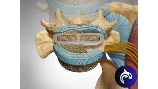 Quick View  Lateral Lumbar Interbody Fusion LLIF  3D Animation [upl. by Walker]