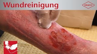 Wundreinigung Debridement bei chronischer Wunde  Verbandswechsel  DRACO [upl. by Melda]