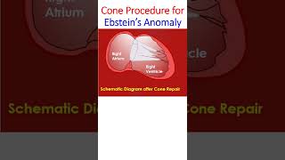 Cone Procedure for Ebstein’s Anomaly [upl. by Erick]