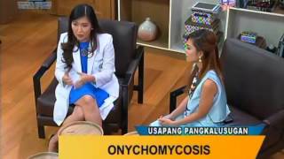 Good Morning Kuya Onychomycosis Fungal Nail Infection [upl. by Ocicnarf]