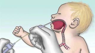 Demonstration of Extubation Procedure by C Smallwood  OPENPediatrics [upl. by Yemrots]