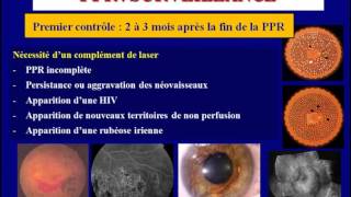 traitement au laser de la retinopathie Diabetique [upl. by Meris957]