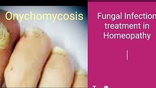 Onychomycosis In Homeopathy quick treatment [upl. by Antrim]