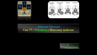 Ultrasound Case 77 Polysplenia Heterotaxy Syndrome [upl. by Julita]