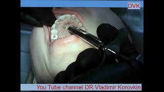 Infiltration Anesthesia for treatment 1112 teeth [upl. by Gereron]