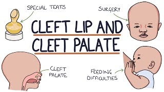 Cleft Lip and Cleft Palate For Students [upl. by Lleuqram]