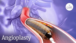 How is Angioplasty Done  Radial Access Procedure  PostTreatment Care After Angioplasty [upl. by Arraek283]