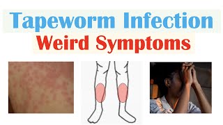 Weird Symptoms of Tapeworm Infection Skin Psychological Neurological [upl. by Netnerb]