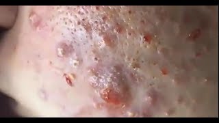 remove blackheads  face skin care  face care 2019 [upl. by Howlond21]