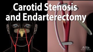 Carotid Stenosis and Carotid Endarterectomy Animation [upl. by Inimak]