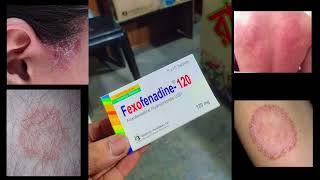 Allegra Tablet Fexofenadine 120 mg Use Dose Side Effects and Price in bengali [upl. by Hecht]