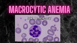 macrocytic anemia diagnosis Practical points [upl. by Appledorf]