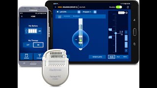 Deep brain stimulation  Percept Neurostimulator [upl. by Adnoma]