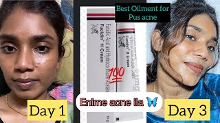 Best Oilment for pus acne  pimples [upl. by Munsey]