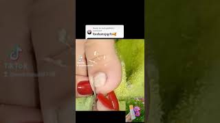 Satisfying toenail removal nail​​​ asmr fyp ear shorts viral wax [upl. by Hsan]