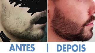 Minoxidil Kirkland  Barba  Antes e Depois  5 Meses [upl. by Taggart]